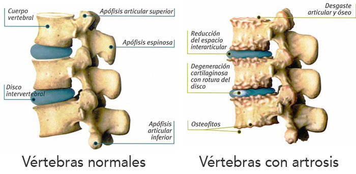 artrosis espalda