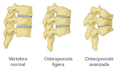 osteoporosis espalda