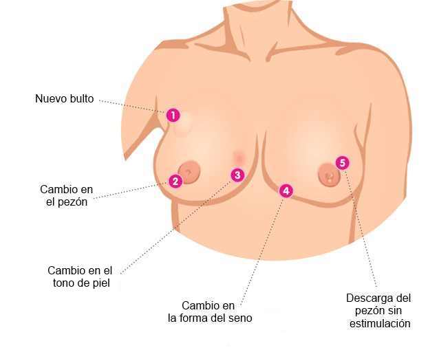 signos del cancer de mama